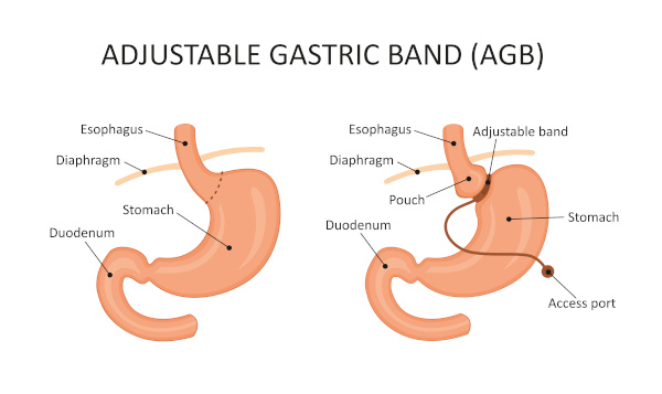 Bariatric Surgery - Laparoscopic Gastric Band