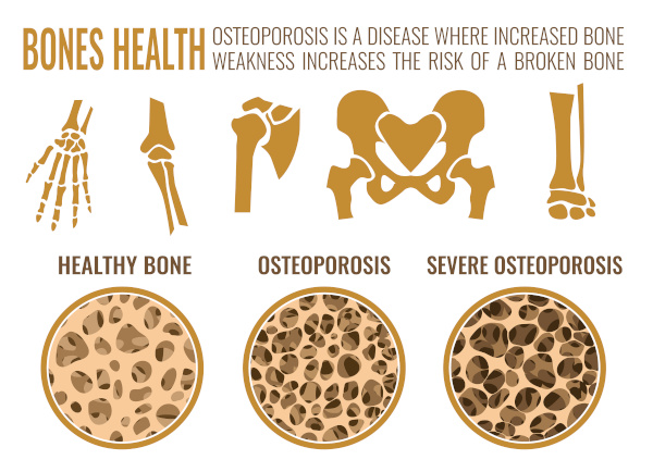 Bariatric Surgery increases the risk of Osteoporosis from Malabsorption of essential calcium