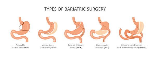 How to Lose Weight ; Bariatric Surgery Types